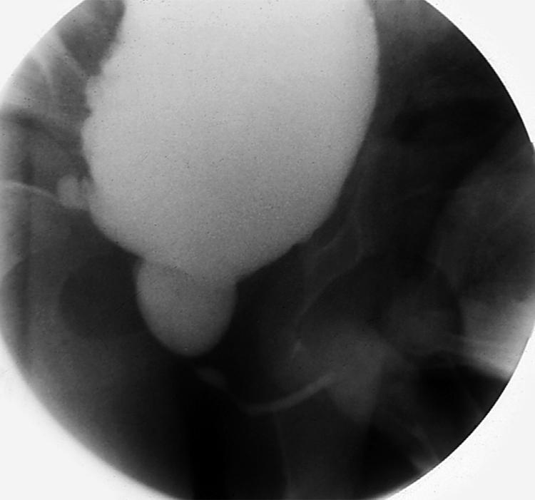 Fig. 15.21, Voiding dysfunction. Voiding cystourethrogram of a boy with Hinman-Allen syndrome shows severe dilation of the prostatic urethra thought to represent urethral valves. Severe bilateral hydronephrosis resulted from vesicoureteric reflux.