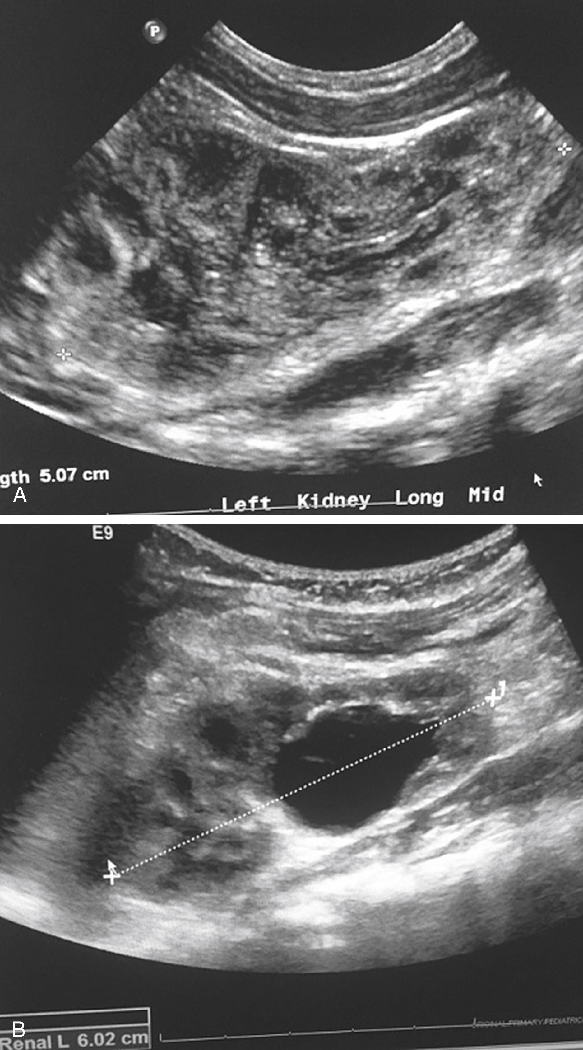 Fig. 15.4, Postnatal hydronephrosis. (A) Renal ultrasound at day of life 1 shows mild left lower pole dilation. (B) Renal ultrasound at 2 months old reveals increased left lower pole dilation not identified on day of life 1 ultrasound, likely secondary to the naturally dehydrated state of a newborn infant.