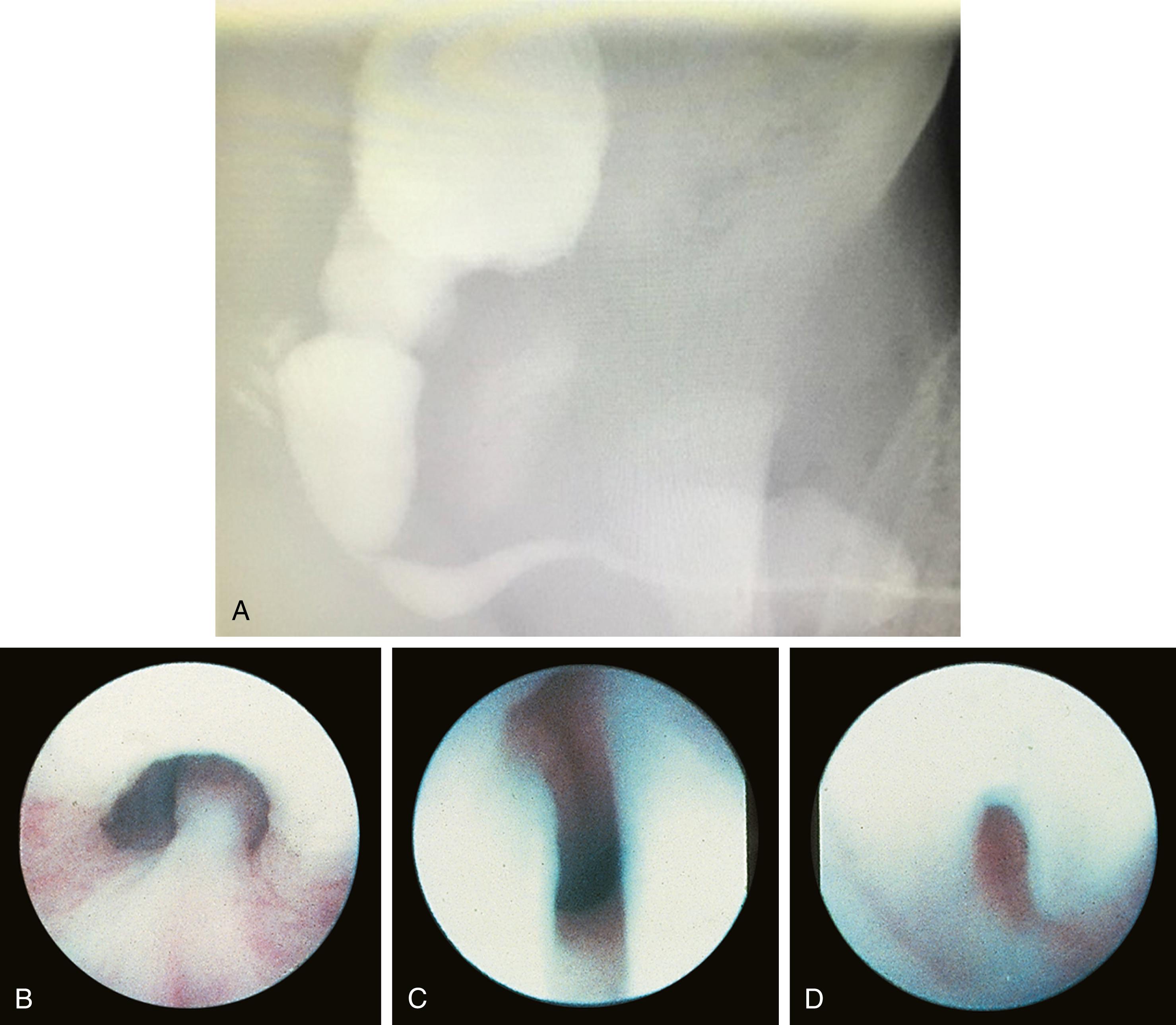 Fig. 15.5, Posterior urethral valves. (A) Voiding cystourethrogram performed in the neonatal period demonstrating a dilated posterior urethra with a filling defect noted where the posterior urethral valves are located with a transition to a normal anterior urethra. (B) Endoscopic view of a normal posterior urethra and verumontanum. (C) Type II urethral valves. The sail-like right and left leaflets are partially disrupted superiorly. (D) Type III urethral valves. These almost complete iris-diaphragm valves cause a more significant obstruction than type II leaflets.