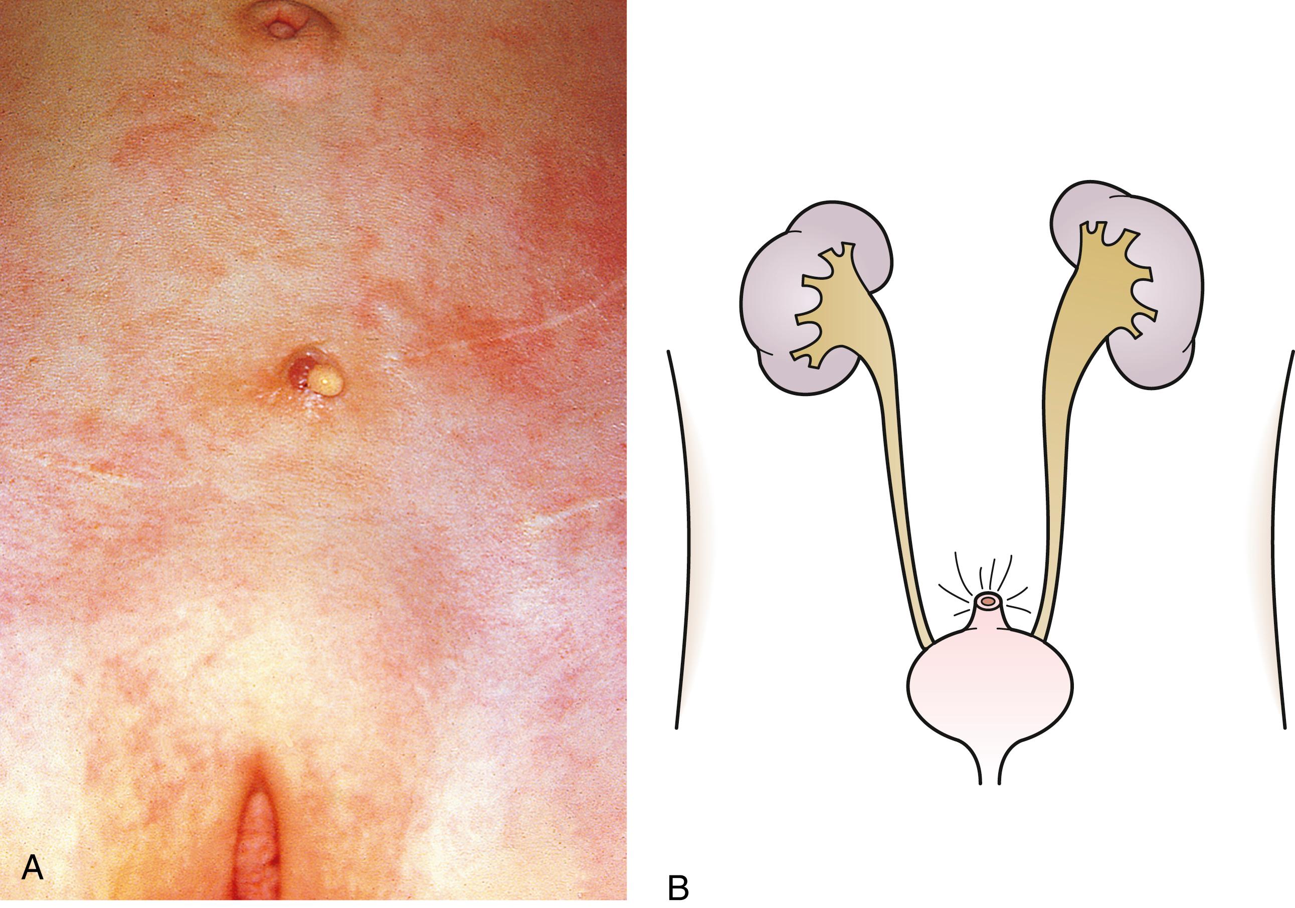 Fig. 15.6, (A and B) Cutaneous vesicostomy.