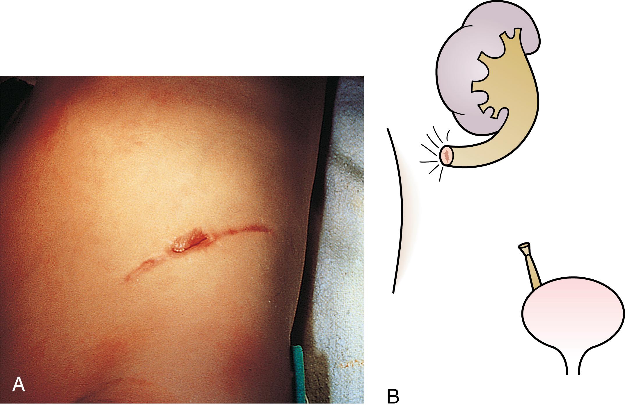 Fig. 15.7, (A and B) End ureterostomy.