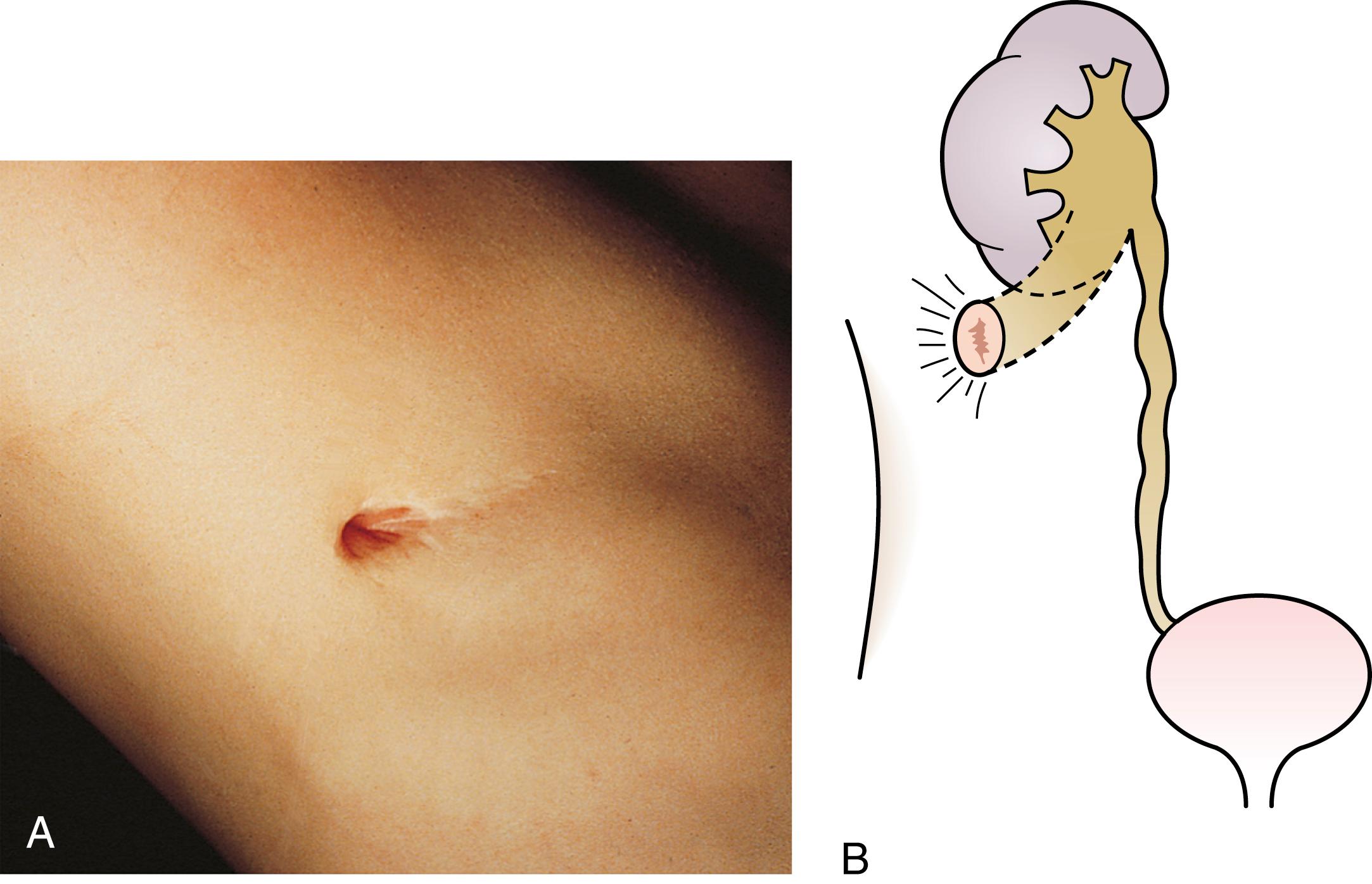 Fig. 15.8, (A and B) Cutaneous pyelostomy.