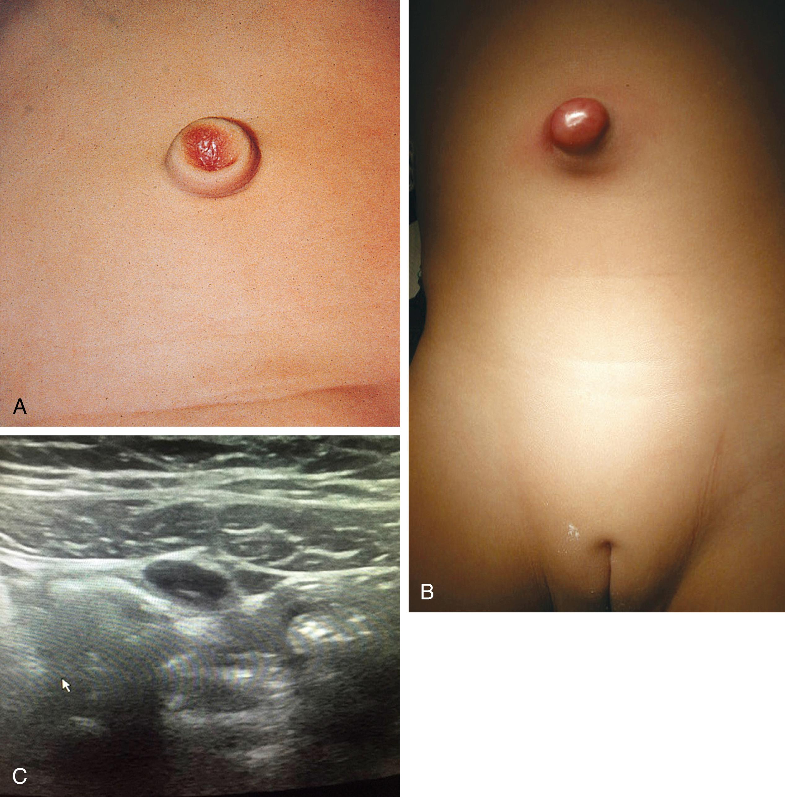 Fig. 15.10, Urachal anomalies. (A) Patent urachus in a girl with recurrent umbilical drainage and inflammation. (B) Urachal abscess in a girl presenting with fever and abdominal pain. (C) Ultrasound image of a urachal cyst found incidentally during evaluation for abdominal pain.