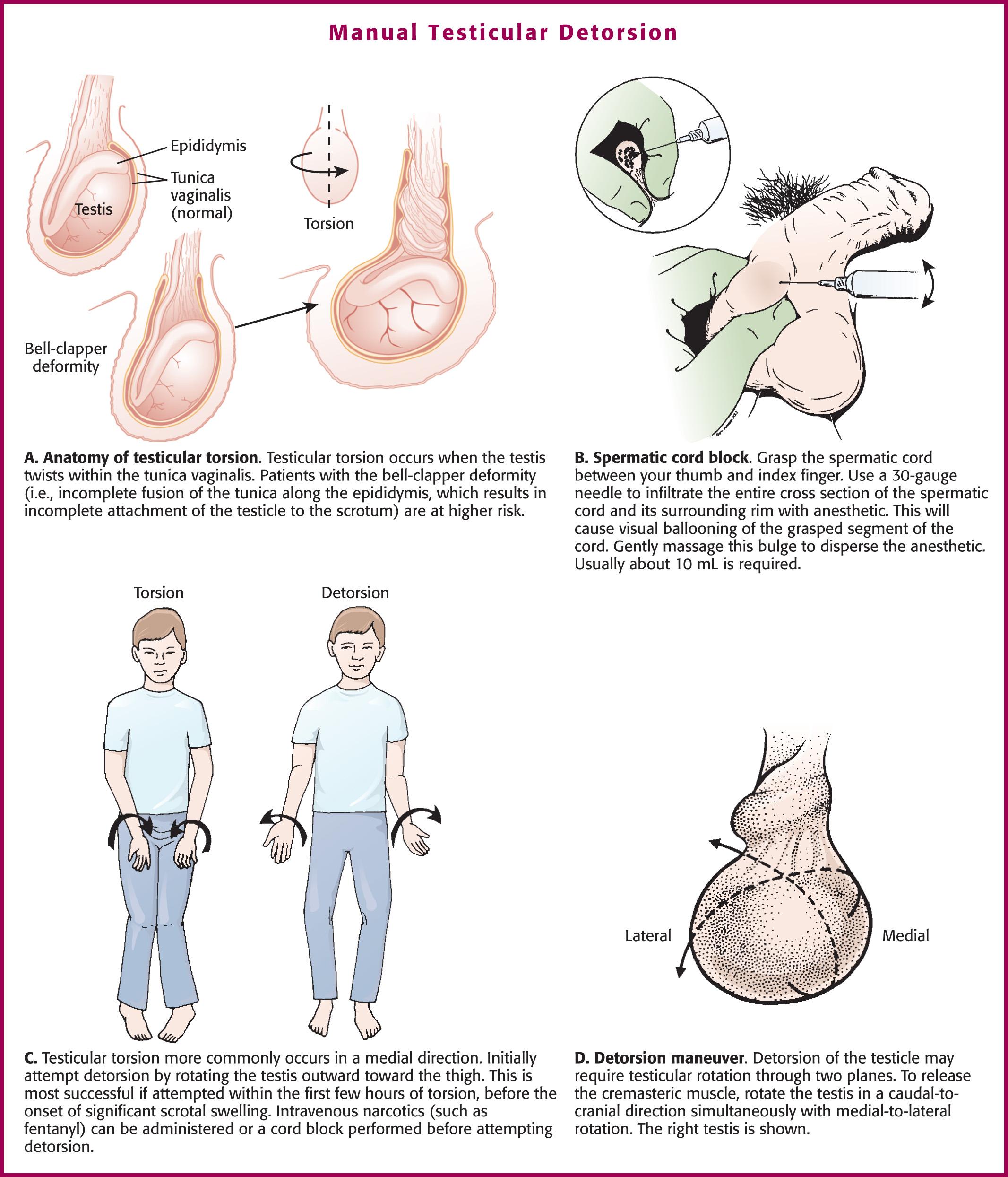 Figure 55.1, A, Anatomy of testicular torsion. B, Achieve anesthesia of the spermatic cord by injecting lidocaine at the superficial inguinal ring.