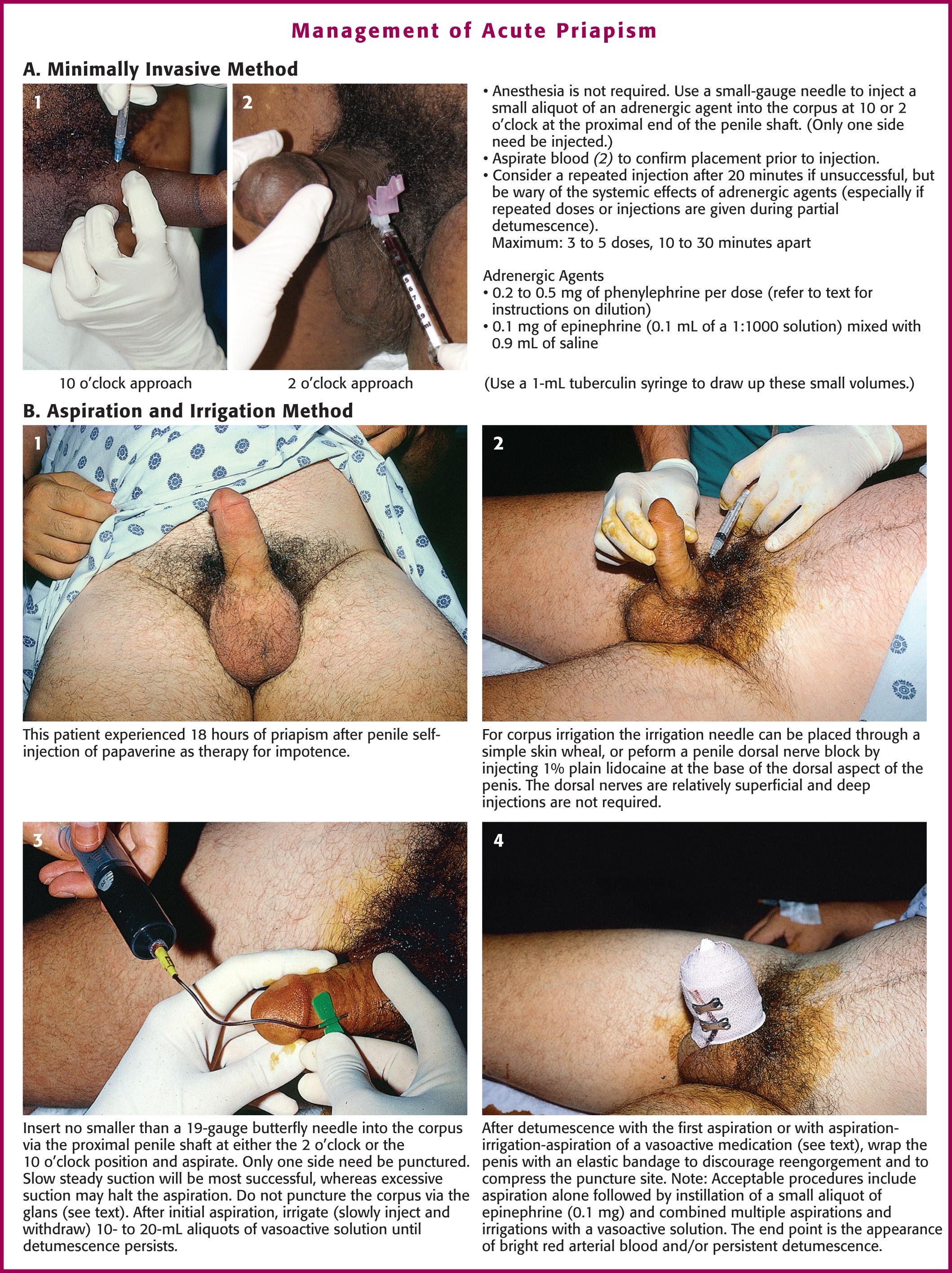 Figure 55.5, Management of acute priapism. The minimally invasive technique ( A ) consists of directly injecting the corpus with a small aliquot of an adrenergic agent. This is often successful and can be used at home by a motivated patient with recurrent problems (such as sickle cell disease). It may require multiple injections and 15 to 20 minutes to be effective.