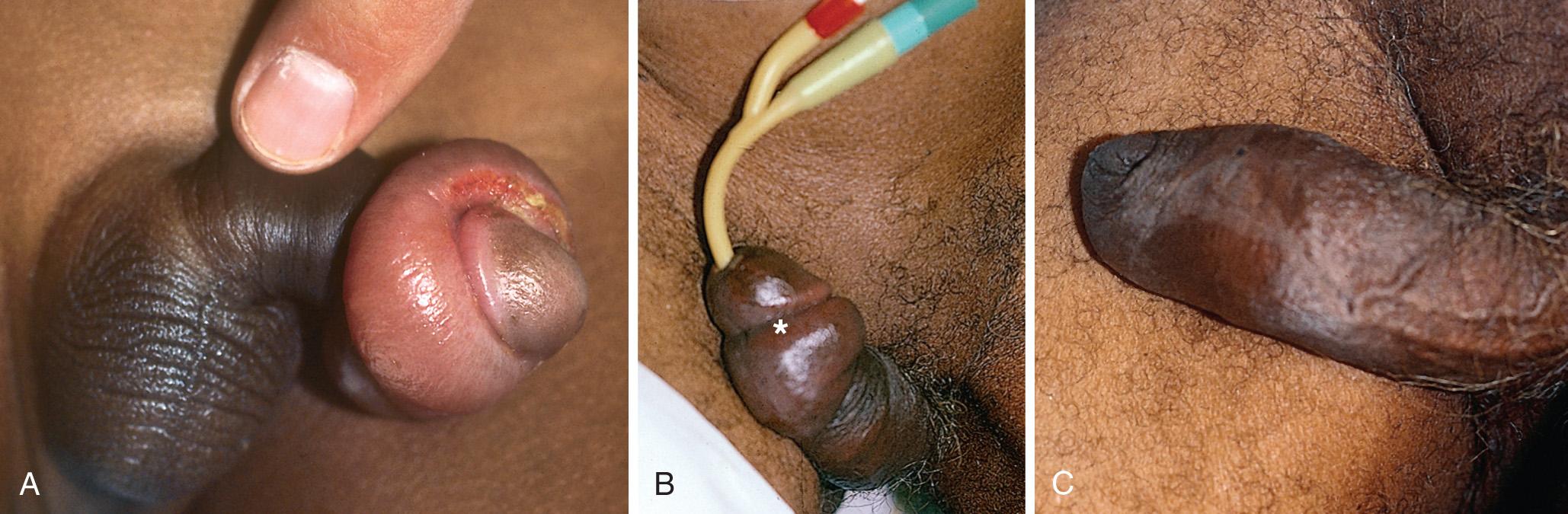 Figure 55.7, Paraphimosis often occurs in the extremes of life. A, Uncircumcised boy with paraphimosis. This may be mistaken for infection or localized trauma, especially if it is unclear whether circumcision has been performed. Always seek this history. B, Paraphimosis, pictured here, may be mistaken for penile trauma, angioedema, or infection. Note that the swollen tissue is proximal to the coronal sulcus (asterisk). The cause of paraphimosis in this case was failure to replace the foreskin after a catheter change in an uncircumcised nursing home patient. Before reduction, the catheter is usually removed. When the edema is minimal, the catheter may be left in place during reduction. C, Appearance of the penis after catheter removal and foreskin reduction.