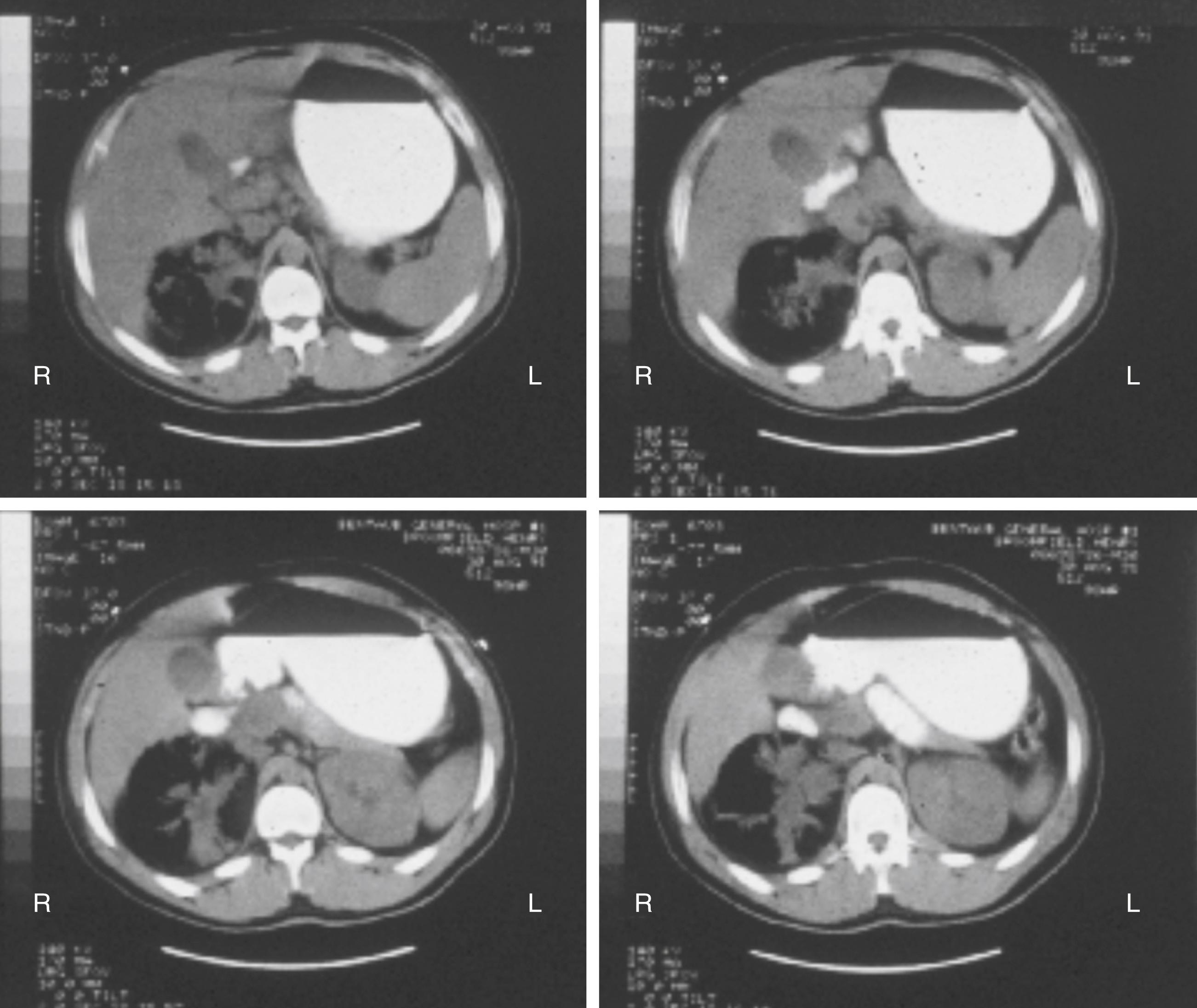 Fig. 74.1, Emphysematous pyelonephritis. This computed tomography (CT) scan demonstrates extensive destruction of the right kidney with intraparenchymal gas on the right, obliterating the renal architecture. The left kidney is normal.