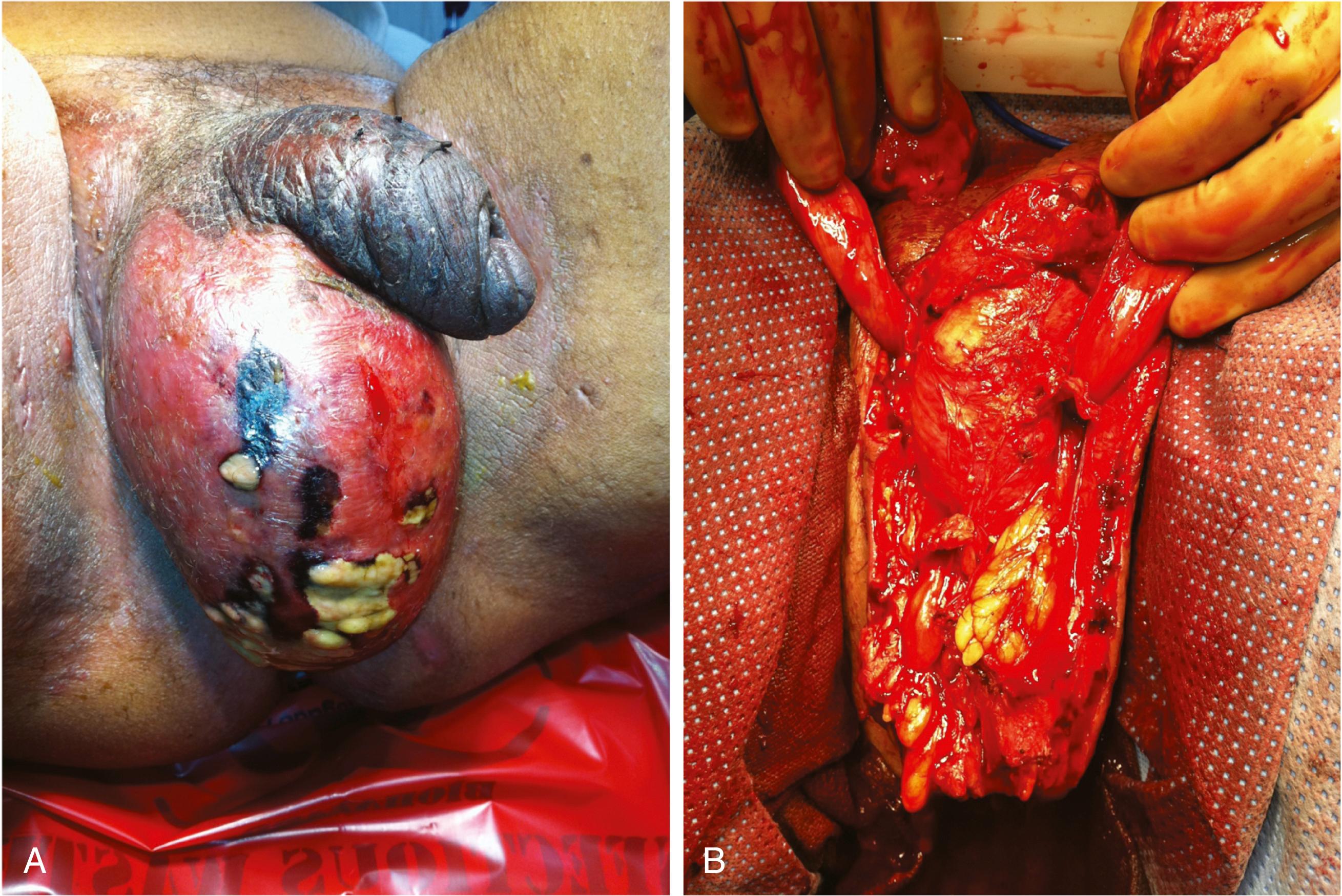 Fig. 74.2, Fournier gangrene. (A) Skin necrosis, purulence, and edema of the scrotum. The skin can also appear normal, with much more subtle physical findings in some cases. (B) Appearance after extensive debridement of scrotal skin and underlying tissues. The base of the penis is visible centrally; the testes are elevated out of the field, and the spermatic cords are visible anteriorly.