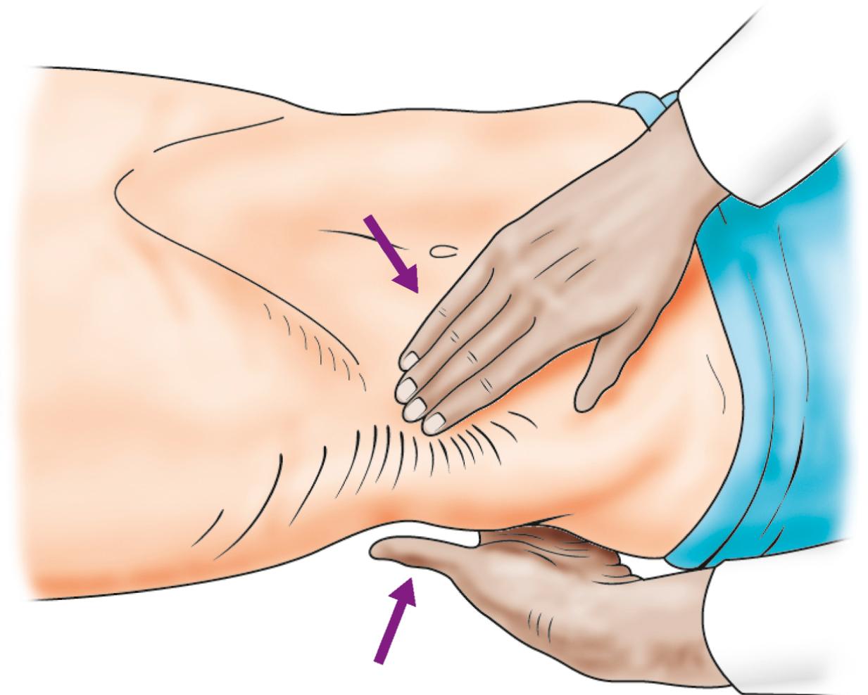 Fig. 24.1, Bimanual palpation of the right kidney.