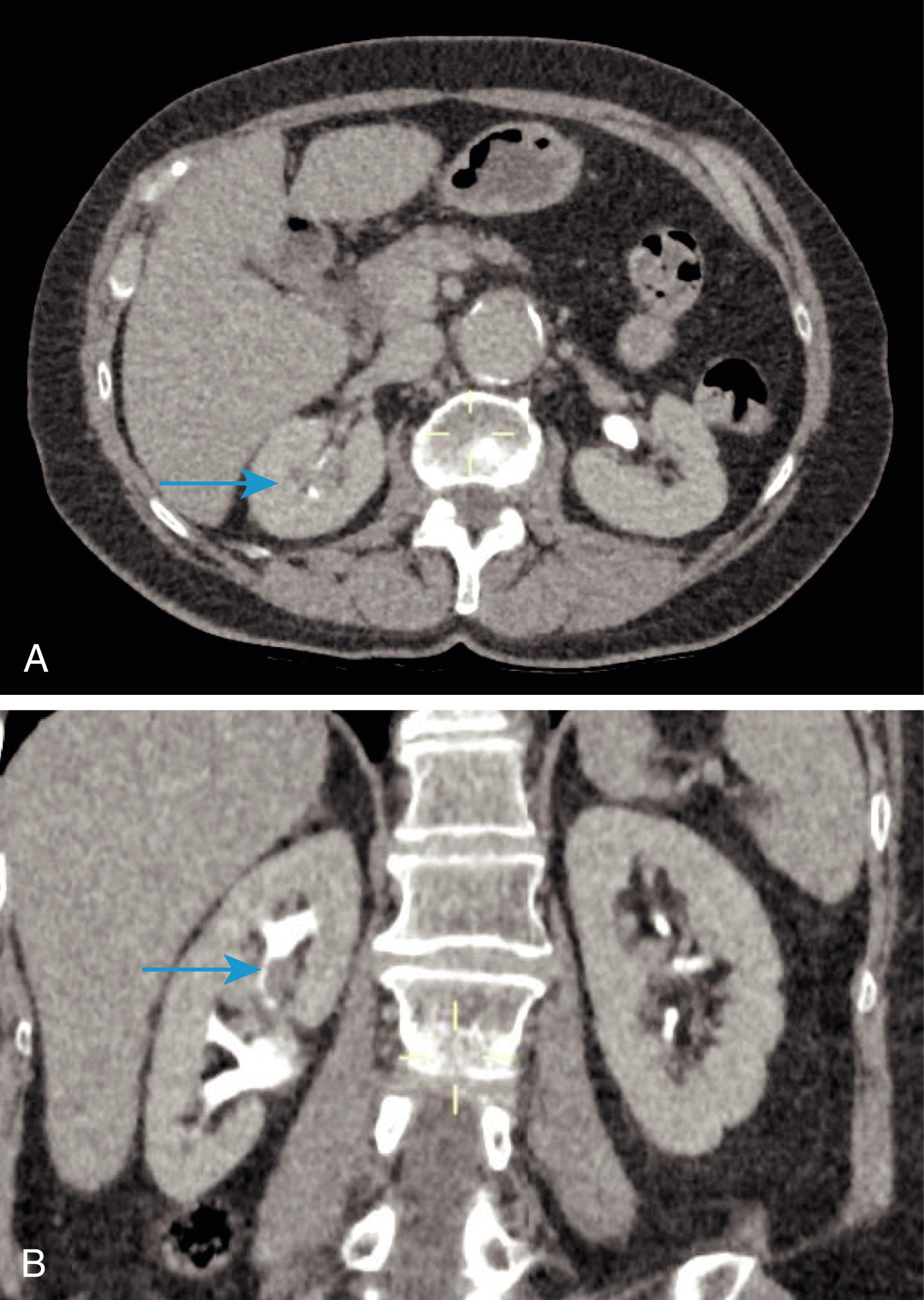 Fig. 24.3, CT urogram in a patient with visible haematuria. This shows a filling defect in the upper pole of the right kidney. The patient had a diagnostic ureteroscopy and biopsy, which confirmed urothelial cancer. A – axial, B – coronal reconstruction.