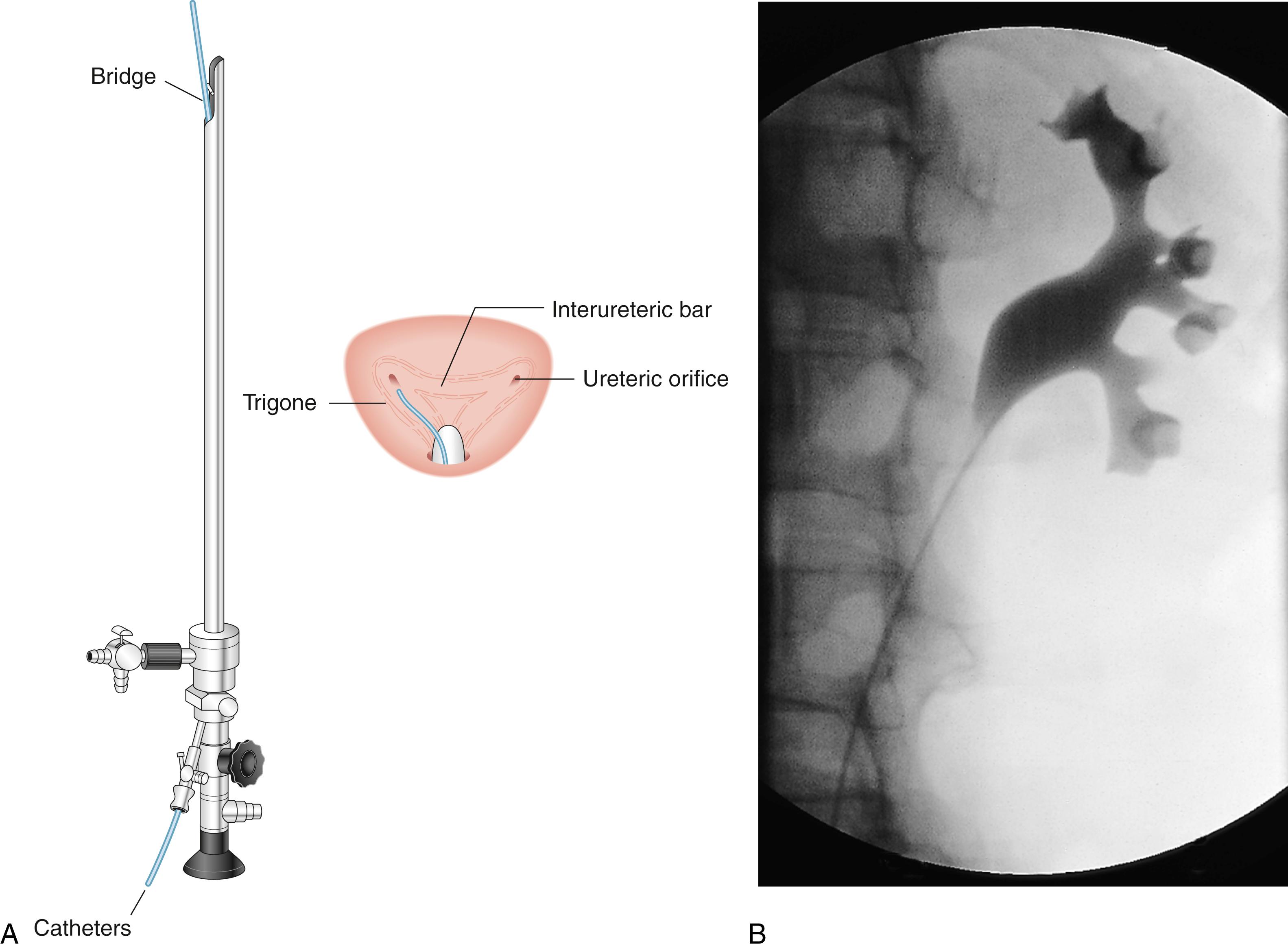 Fig. 24.4, Retrograde ureteropyelography.