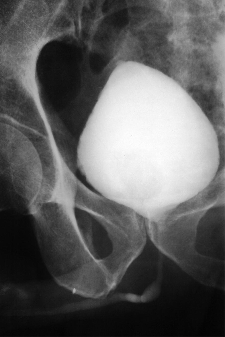 Fig. 24.5, Micturating cystourethrogram. Shows opacified and well-distended bladder, and a normal urethra in a male patient.