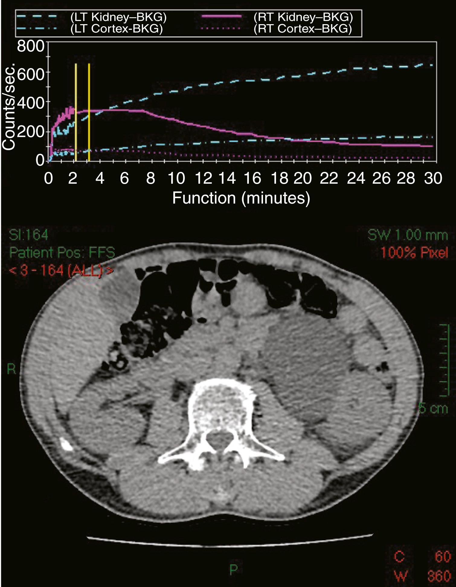 Fig. 24.6, MAG-3 ( 99m Tc-labelled dimercaptoacetyltriglycine) scan ( left panel ) and accompanying CT ( right panel ). The MAG-3 renogram curve demonstrates a normally draining right kidney (the curve started to drop towards baseline after 7 minutes), whereas the curve for the left kidney continues to rise, despite the administration of a diuretic, suggesting an obstructed kidney. CT shows left-sided hydronephrosis; the patient was found to have a pelviureteric junction obstruction and treated with a pyeloplasty.