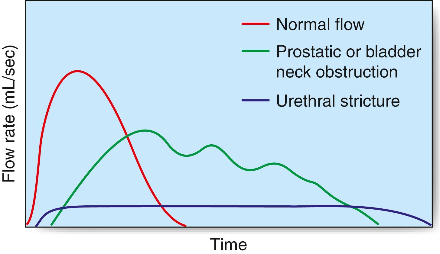 Fig. 24.7, Urinary flow rates. The normal flow rate shows a rapid rise to maximum high-peak flow. In a typical bladder outflow obstruction due to benign prostatic hyperplasia, there is a slow rise to poor maximum flow rate and prolonged variable flow. In a typical urethral stricture, there is prolonged flow with little variability, giving a plateau- or box-shaped curve.