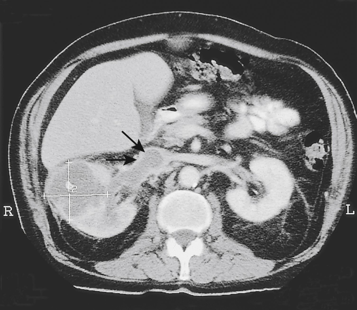 Fig. 24.9, Contrast-enhanced CT of renal cancer. The right kidney is expanded by a low-density cancer that fails to take up the contrast. Tumour is seen extending into the renal vein and inferior vena cava ( arrow ).