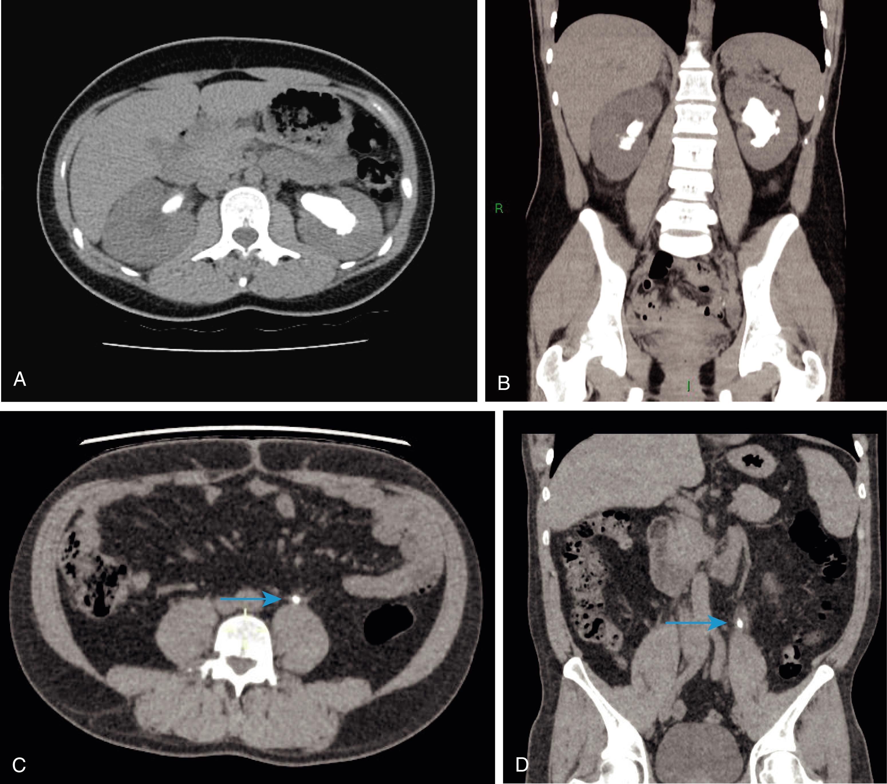 Fig. 24.10, (A-B) Non-contrast computed tomography kidney-ureter-bladder (CT KUB) showing staghorn calculi. (C-D) Non-contrast CT KUB in a patient with renal colic, showing a 6mm stone in the left mid ureter. A and C - axial, B and D - coronal reconstruction.