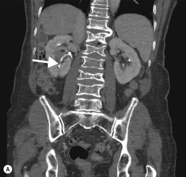 Fig. 31.1, A 75-Year-Old Woman Presenting With Visible Haematuria.