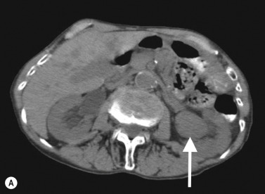 Fig. 31.2, A 72-Year-Old Woman Presenting With Visible Haematuria.