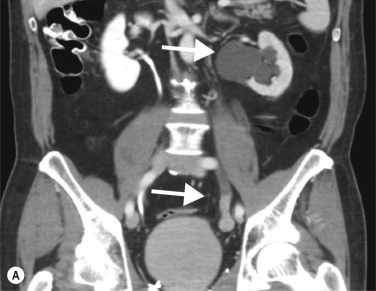 Fig. 31.4, Transitional Cell Carcinoma of the Left Ureter.