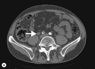 Fig. 31.5, Transitional Cell Carcinoma (TCC) of the Right Ureter (A–B).
