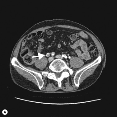 Fig. 31.6, Transitional Cell Carcinoma (TCC) of the Right Ureter (A–B).