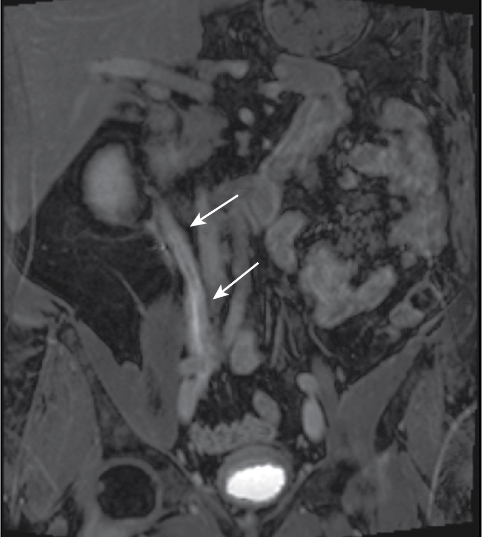 Fig. 27.1, 48-year-old man who presented with gross hematuria. Excretory magnetic resonance urography images demonstrate long-segment diffuse right urothelial thickening with thin preserved ureteral lumen containing excreted contrast ( arrows ). Biopsy confirmed ureteral amyloidosis.