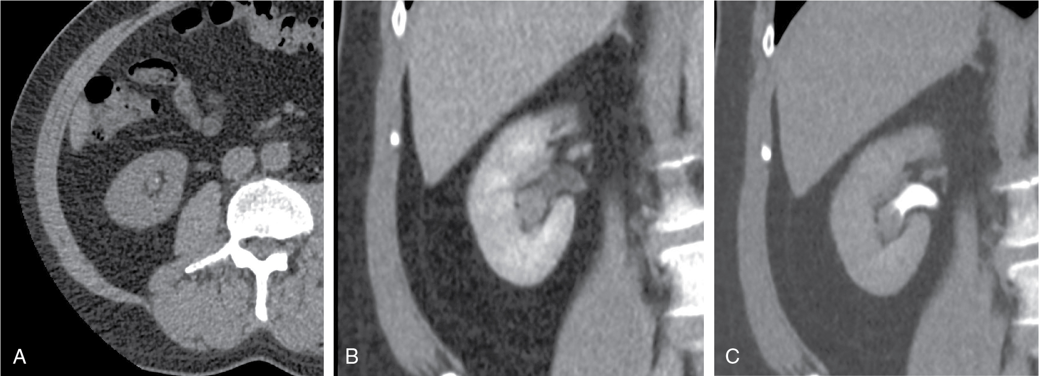 Fig. 27.2, 63-year-old man with hematuria presents for computed tomography urography. Noncontrast axial image through the right renal lower pole (A) demonstrates soft-tissue density with focal calcification within the calyx. Nephrographic phase (B) shows lesion enhancement whereas the excretory phase (C) clearly outlines the calyceal filling defect. Biopsy consistent with transitional cell carcinoma.