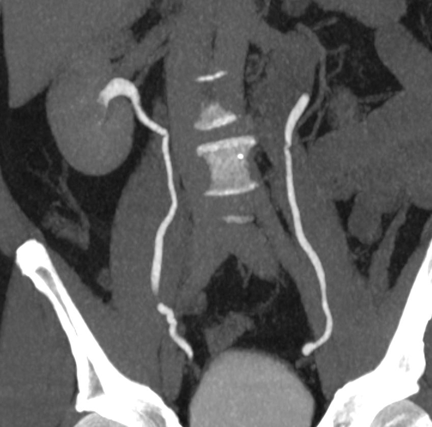 Fig. 27.3, A three-dimensional image reconstruction maximum intensity projection demonstrating bilateral ureters in a single plane.