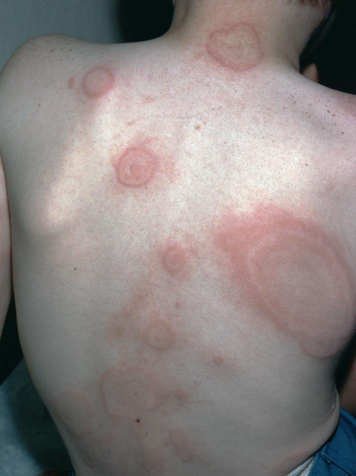 Fig. 3.1, Acute urticaria. Large circumscribed, raised, edematous, red plaques. The itch can be intense. Lesions range from a few to numerous and vary in size and configuration.