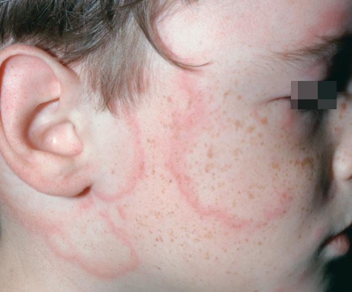 Fig. 3.3, Acute urticaria. Lesions occur on any skin surface, including the palms, soles, and face. They appear in many forms, and each lesion lasts 12 to 24 hours. The most characteristic presentation is a red, raised plaque with central clearing, surrounded by a faint white halo. When confluent, they become polycyclic.