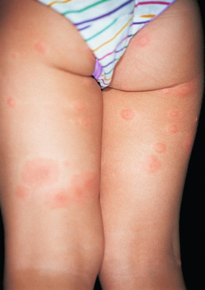 Fig. 3.4, Chronic urticaria is common, occurring in up to 25% to 50% of the population. People of all ages are affected, but the highest incidence is in young adults.