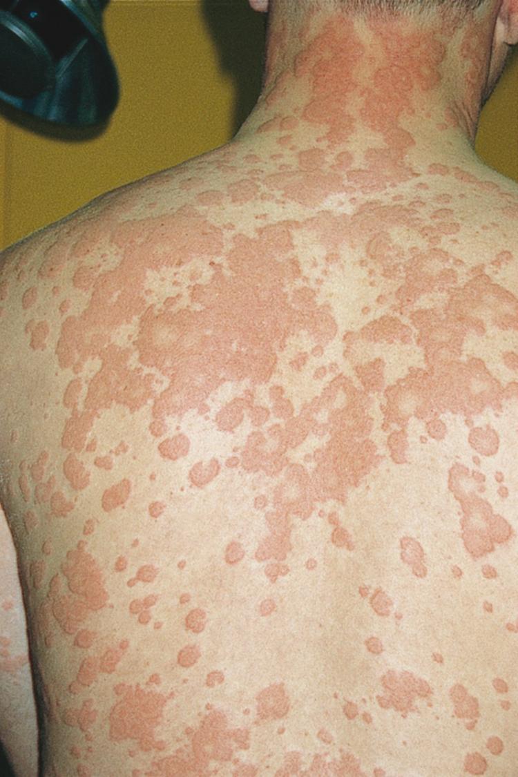 FIGURE 232-2, Extensive urticaria.