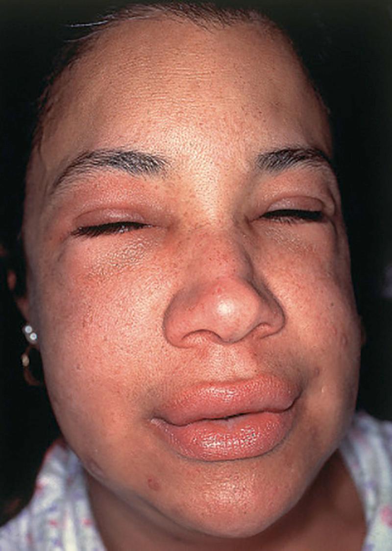 FIGURE 232-3, Angioedema.