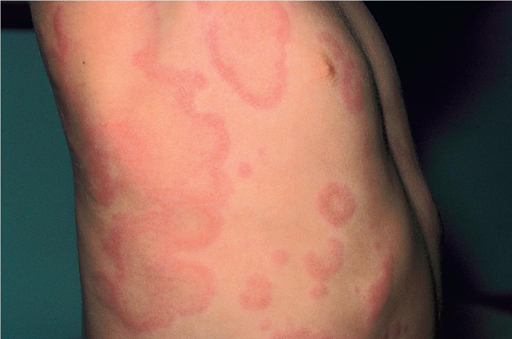 Fig. 20.2, Urticaria. Transient well-circumscribed erythematous wheals occurred in this girl as a reaction to administration of cefixime. Note the edematous center and halo of erythema. Circling a lesion and noting whether it is clear 24 hours later facilitates diagnosis.