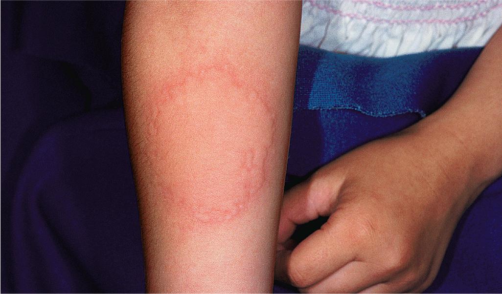 Fig. 20.12, Cold urticaria. Application of an ice pack to an extremity for 2 to 10 minutes can induce a wheal.