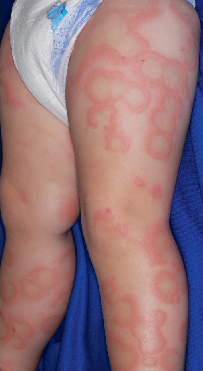 Fig. 20.14, Serum sickness–like reaction. Serpiginous and annular lesions that persisted more than 24 hours in a reaction to amoxicillin.