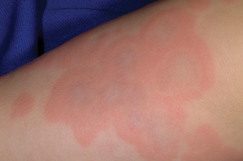 Fig. 20.15, Serum sickness–like reaction (SSLR). Note the central lilac discoloration, similar to that of erythema multiforme and typical of SSLR. This girl developed the reaction after 10 days of amoxicillin.