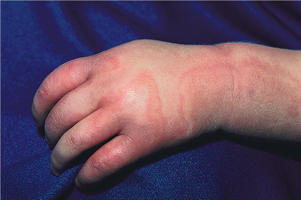 Fig. 20.16, Serum sickness–like reaction (SSLR). Note the swollen hand and large urticarial wheals in this girl with SSLR and arthralgias.