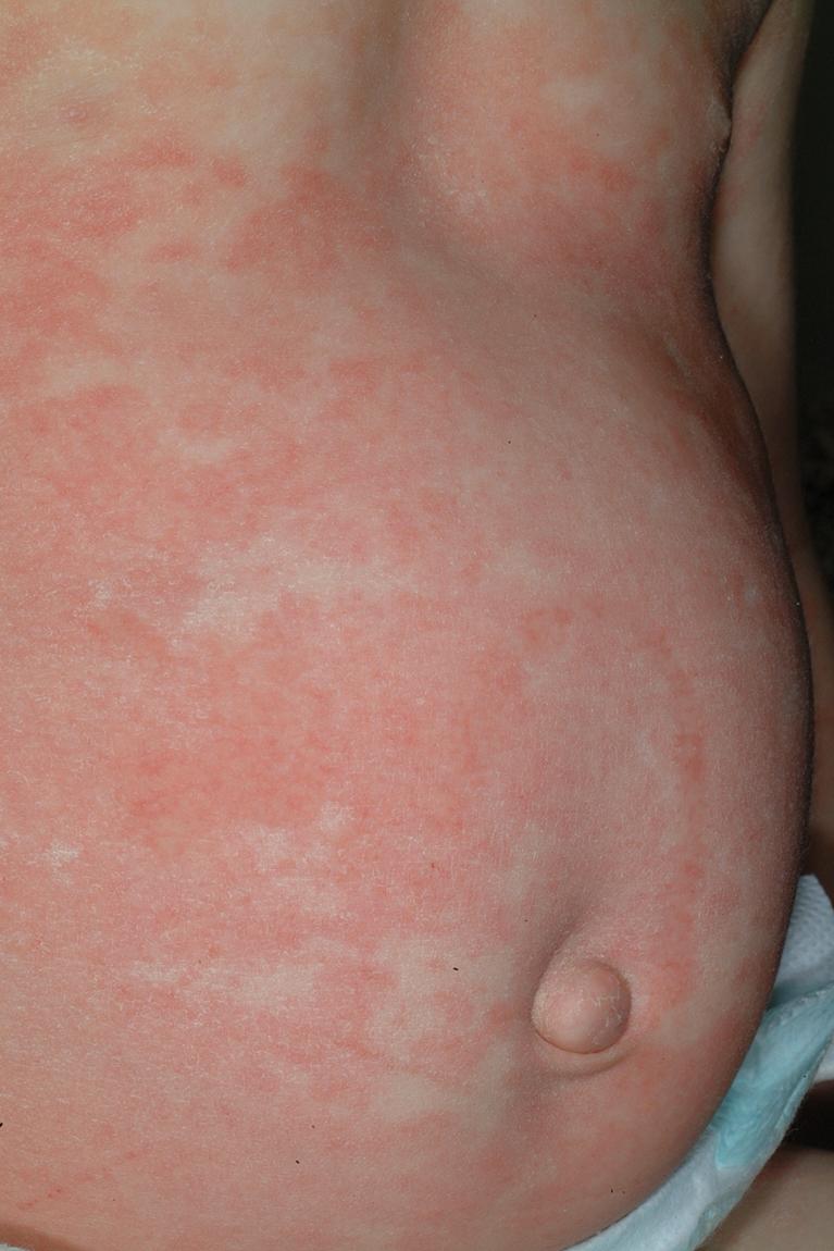 Fig. 20.18, Exanthematous drug reaction. Confluence of erythematous macules from administration of cefdinir.