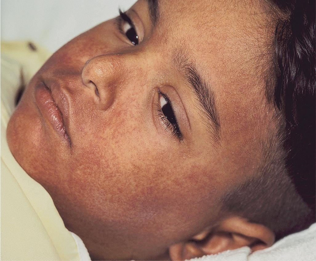 Fig. 20.19, Drug reaction with eosinophilia and systemic symptoms (DRESS). Three weeks after initiation of carbamazepine, this boy developed facial edema with dusky erythematous papules. The pruritic eruption subsequently spread caudally. Hepatic transaminase levels were noted to be significantly increased.