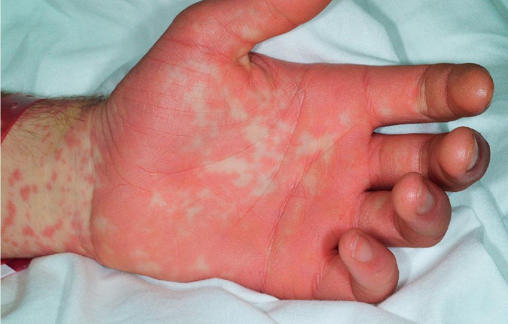 Fig. 20.21, Stevens–Johnson syndrome (SJS). Intensely erythematous macules are nearly confluent the palms of this boy with SJS from carbamazepine.