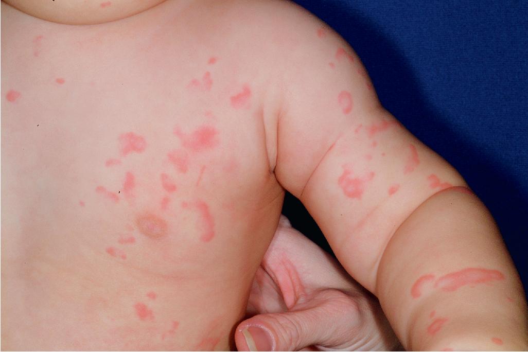 Fig. 20.3, Urticaria. Transient round and annular erythematous macules and slightly edematous plaques represent a reaction to cefdinir in this infant.