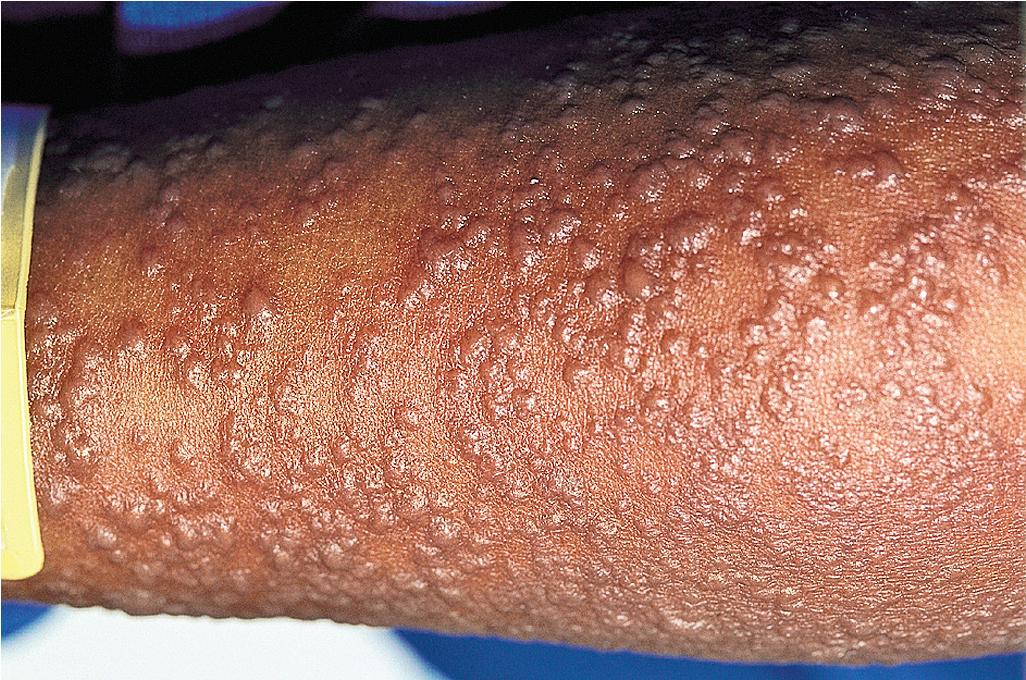 Fig. 20.22, Toxic epidermal necrolysis. Note the extensive small bullae that later coalesced and led to extensive denudation.