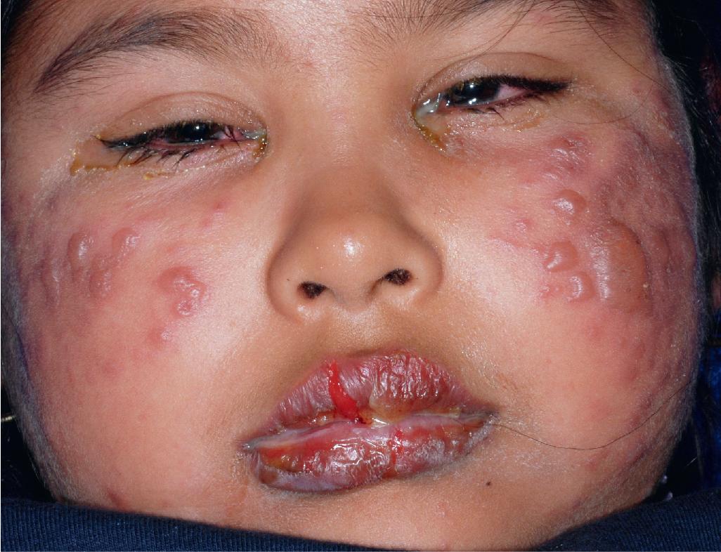 Fig. 20.23, Stevens–Johnson syndrome. Purpuric macules became bullous. Note the inflammation of the conjunctivae and lips.