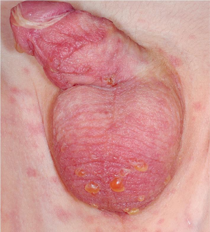 Fig. 20.24, Toxic epidermal necrolysis. Note the discrete bullae on the scrotum sloughing of mucosae at the glans. The sloughed skin resembles wrinkled, wet, tissue paper.