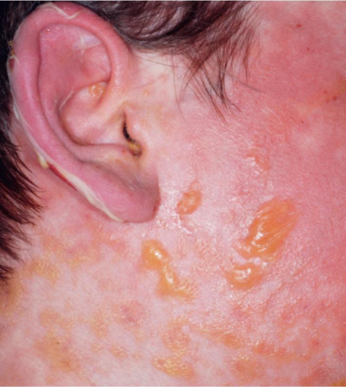 Fig. 20.25, Toxic epidermal necrolysis (TEN). Note the sloughing of skin on the ear, which is exacerbated by gentle stroking of the area (positive Nikolsky sign). The mucosal involvement in this boy originally was typical of Stevens–Johnson syndrome, but he progressed to the extensive denudement of TEN.