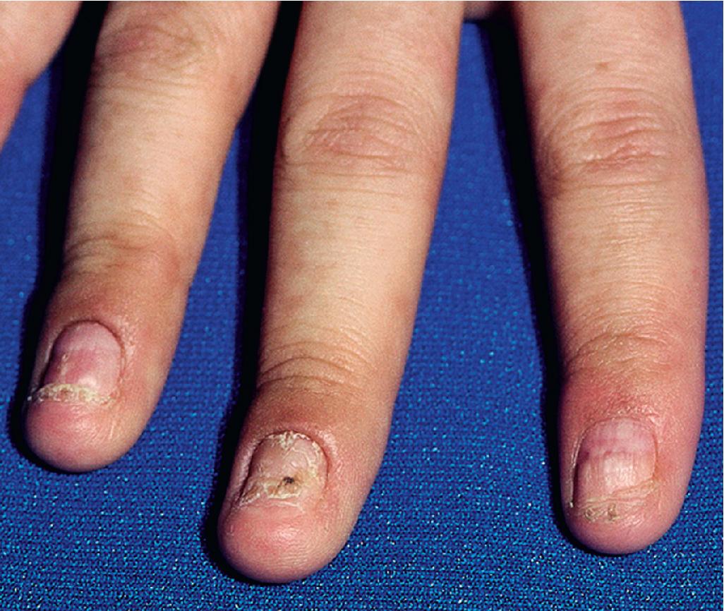 Fig. 20.26, Toxic epidermal necrolysis. Residual nail dystrophy in an adolescent girl who also had widespread postinflammatory hyperpigmentation.