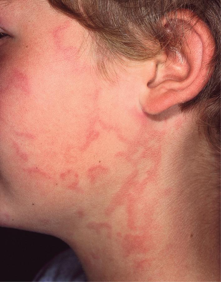 Fig. 20.4, Urticaria. These annular and serpiginous wheals developed within minutes of eating shrimp.