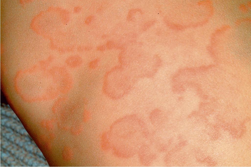 Fig. 20.5, Urticaria. Annular patterns of urticaria can be confused with erythema multiforme, and the term urticaria multiforme has been proposed.