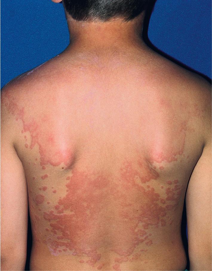 Fig. 20.6, Urticaria. Wheals may coalesce and cover large areas of the body.